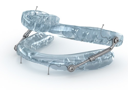 Rendering of a sleep apnea oral appliance 